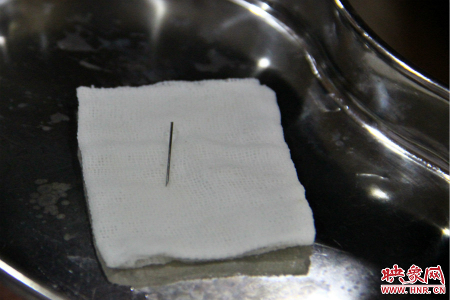上午11點30分許，小龍腦中鋼針已經成功取出。