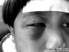 6月2日，網曝渭南市臨渭區一不滿5歲的女童遭奶奶毆打，眼圈青腫，引起網友關注，但孩子父母和爺爺均稱是摔倒導致。相關部門介入調查發現確為奶奶毆打所致，鑒于其身體原因已進行批評教育。