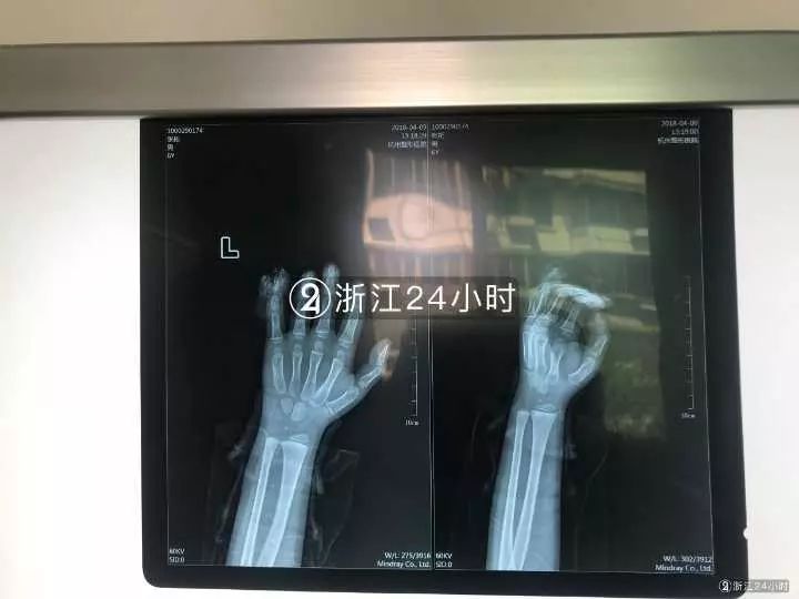 嚇哭！6歲男孩被夾斷手指 罪魁禍首竟是校服