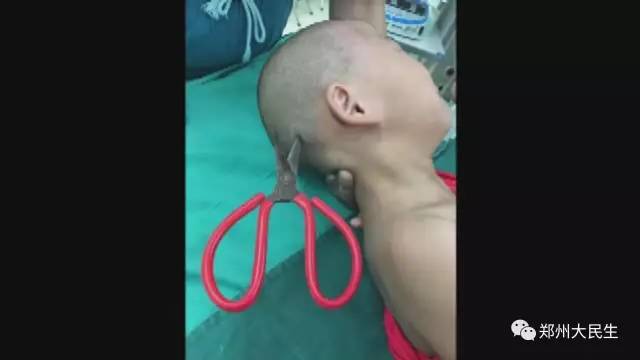 剪刀插入6歲女孩頭部 圖片讓人心驚膽戰