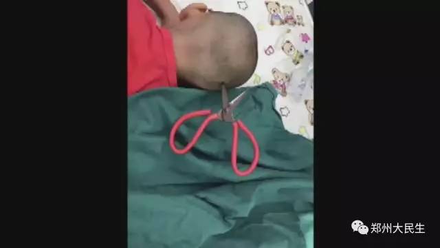 剪刀插入6歲女孩頭部 圖片讓人心驚膽戰