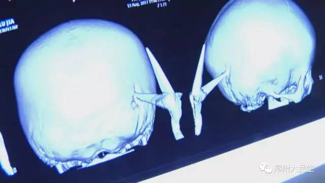 剪刀插入6歲女孩頭部 圖片讓人心驚膽戰