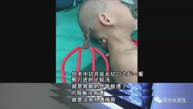 剪刀插入6歲女孩頭部 圖片讓人心驚膽戰