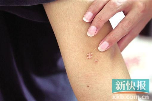 取出針后李星兒手臂留下了傷口。新快報記者 張國鋒/攝