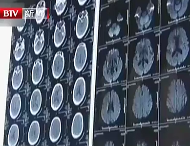 世界卒中日：卒中發病呈年輕化趨勢