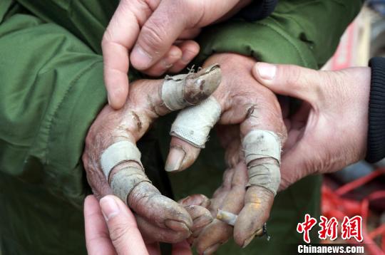 圖為由于常年拾荒，老人雙手布滿傷口。周小云 攝